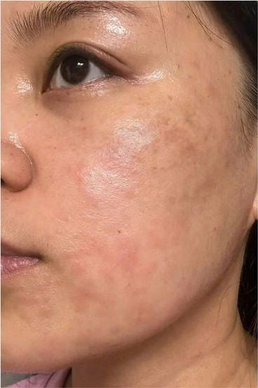 Before and after comparison of a woman's face with visible skin improvement.